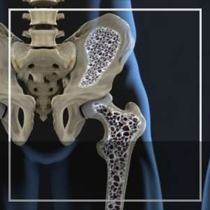 Osteopenia y Osteoporosis
